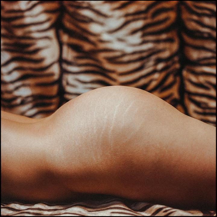 A person's hip and thigh with stretch marks are visible against a tiger print background.