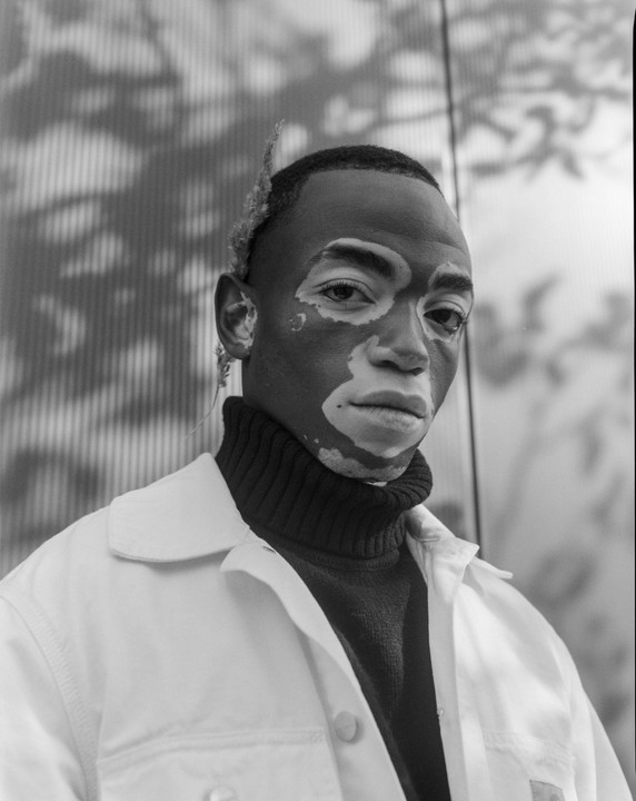 A man with vitiligo and a plant stem behind his ear looks directly at the viewer.