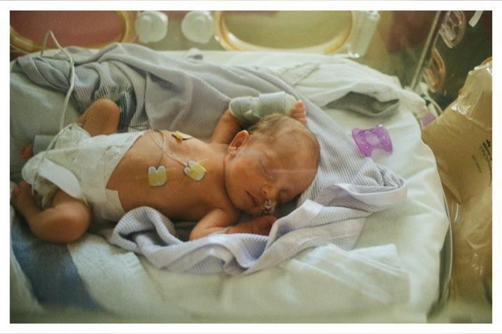 A newborn baby with medical sensors on its chest sleeps on a striped blanket.