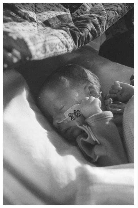 A baby with a feeding tube is sleeping on a blanket.