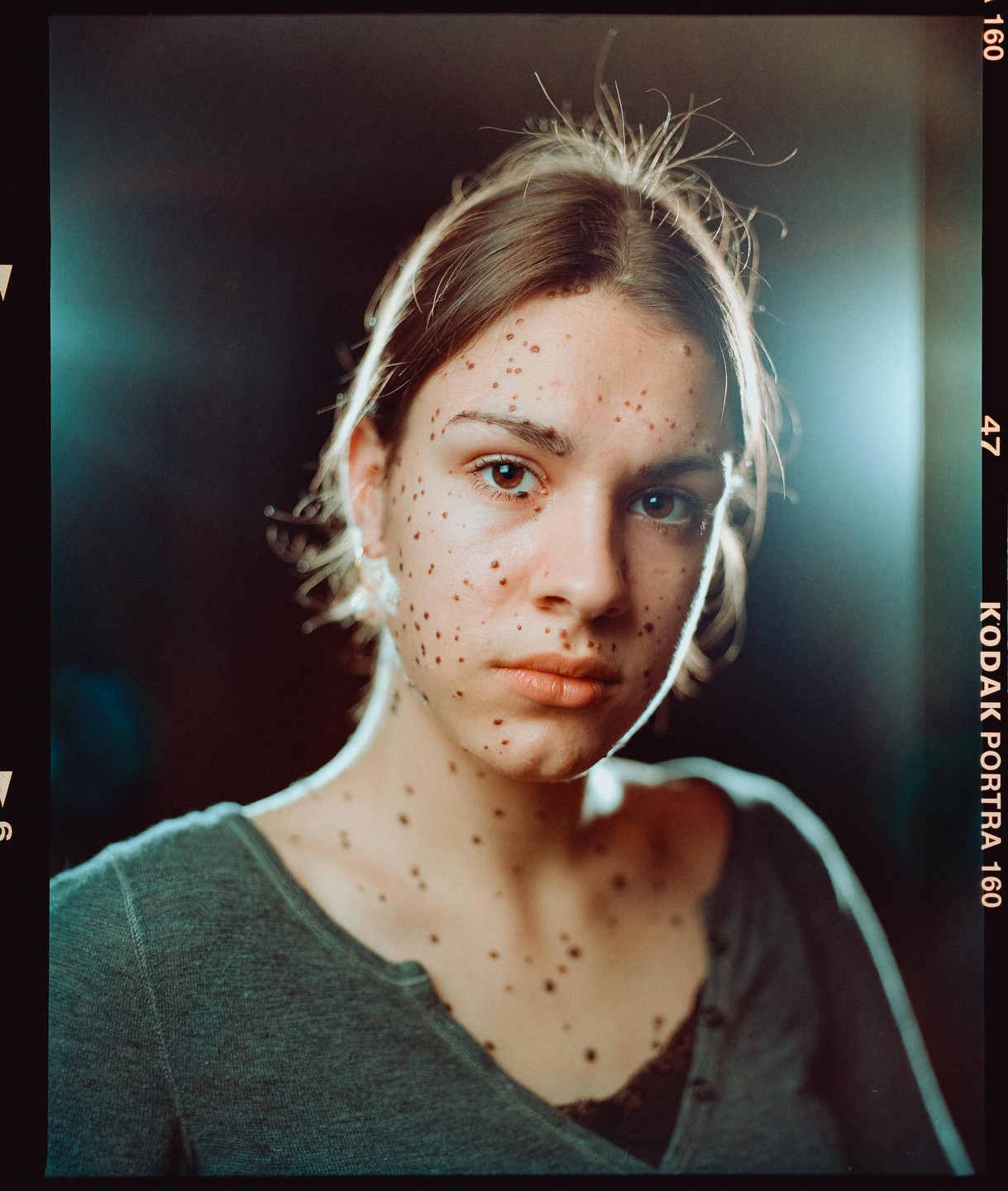 A woman with many moles on her face and neck looks directly at the viewer.