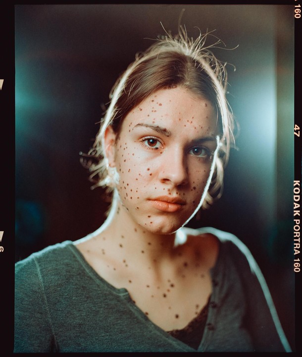 A woman with many moles on her face and neck looks directly at the viewer.