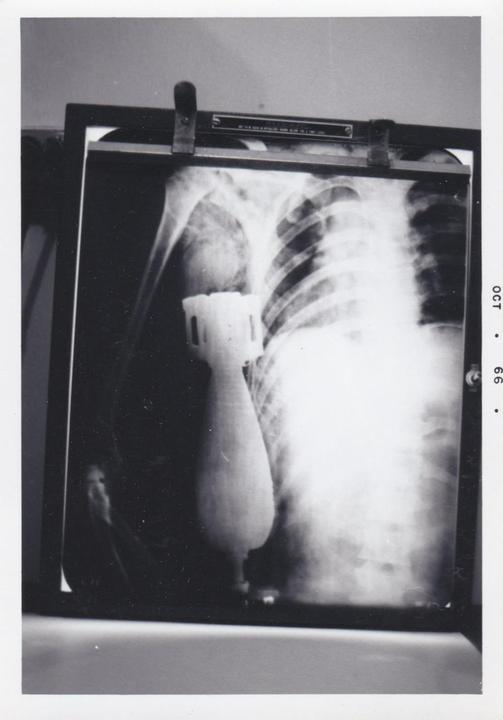 An X-ray shows a bomb-like object inside a person's chest.