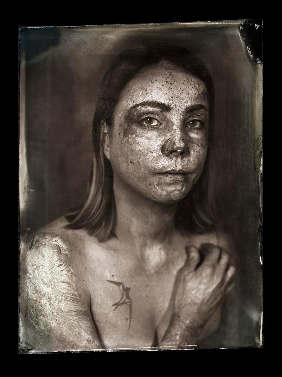 A woman with textured skin and a tattoo on her chest looks directly at the viewer.