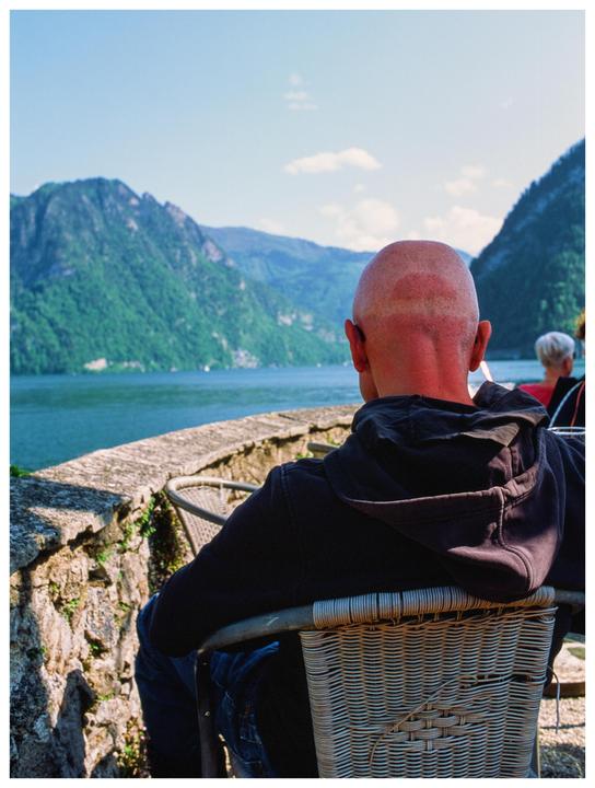 A man with a sunburned head sits in a chair, looking out at a lake surrounded by mountains.