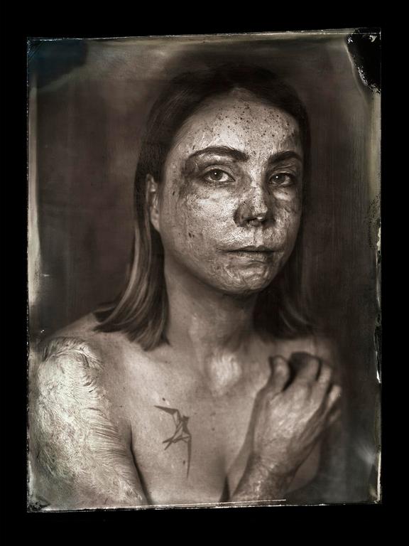 A woman with textured skin and a tattoo on her chest looks directly at the viewer.