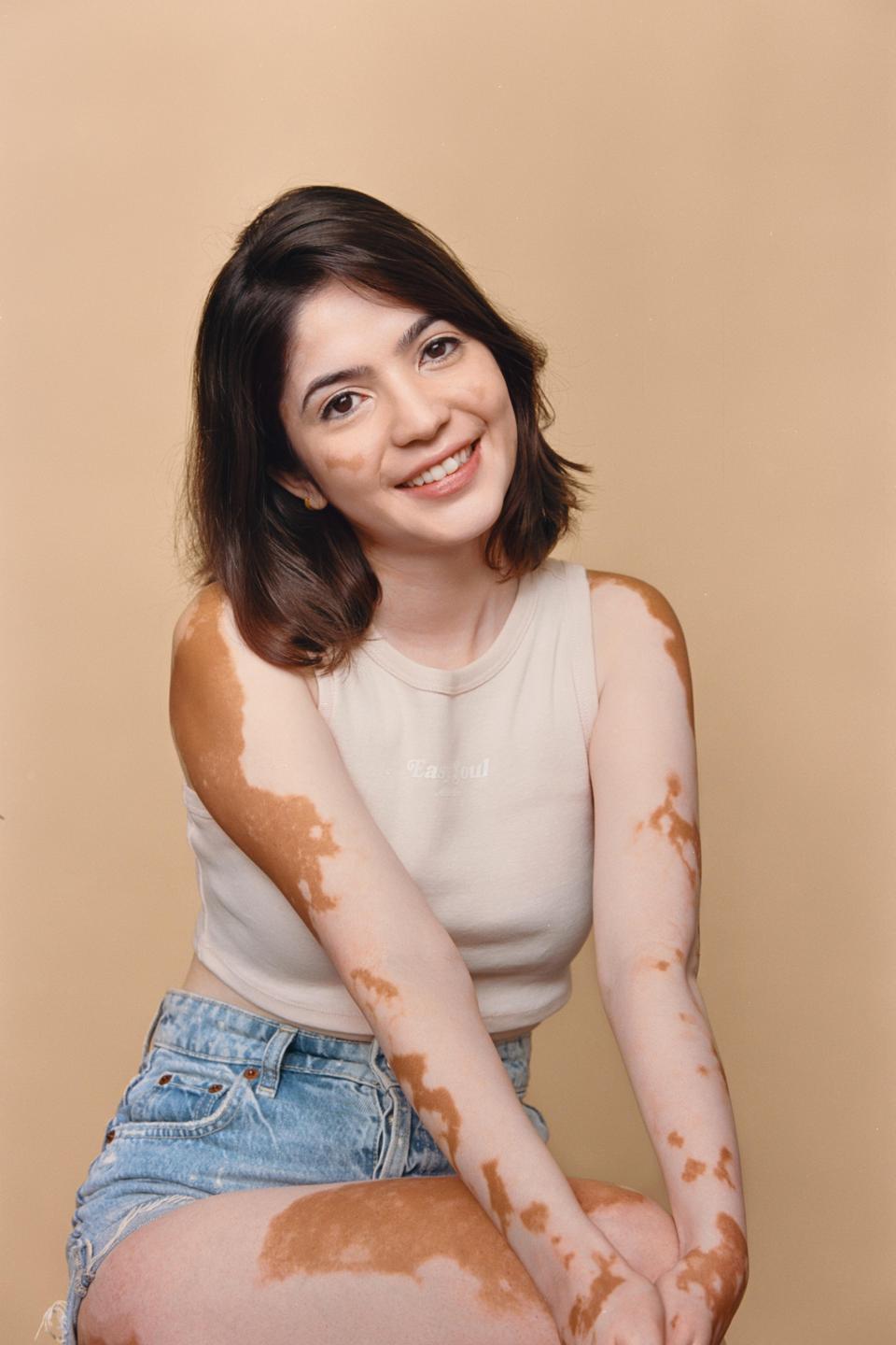 A young woman with vitiligo smiles at the camera while wearing a tank top and denim shorts.